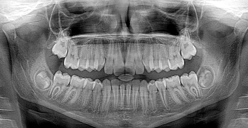 Los Rayos X en los tratamientos dentales