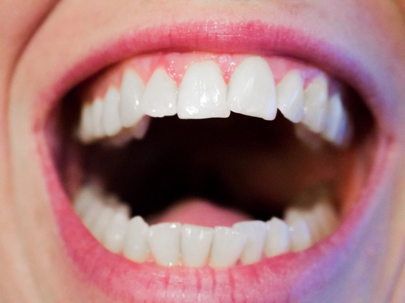 ¿Es posible prevenir la gingivitis?