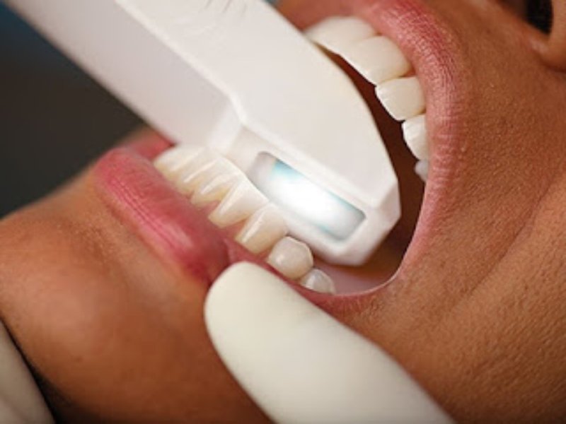 Un nuevo sistema digital escanea los dientes para hacer prótesis