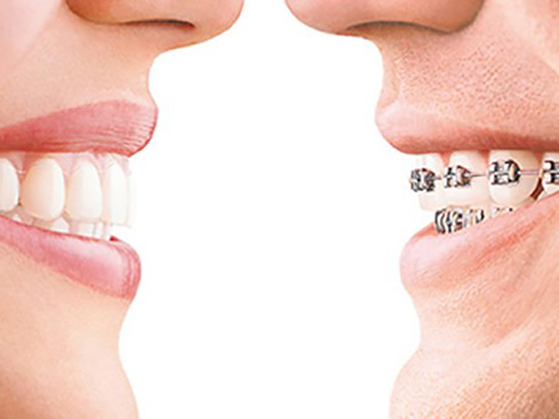Ortodoncia en adultos