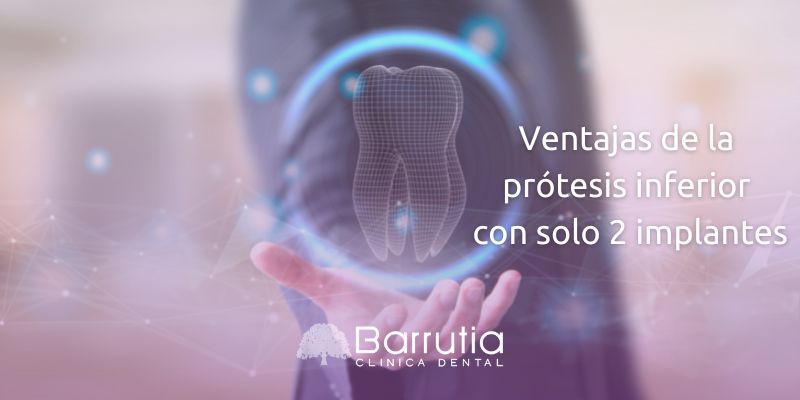 Ventajas de la prótesis inferior con solo 2 implantes