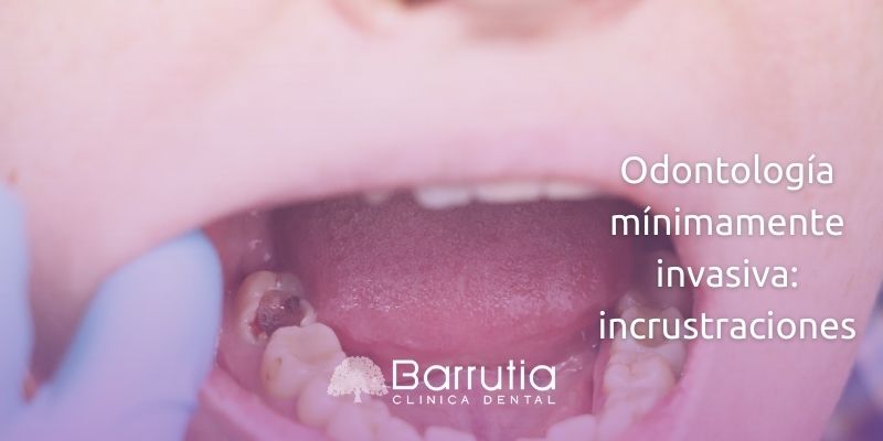 Odontología mínimamente invasiva: incrustraciones