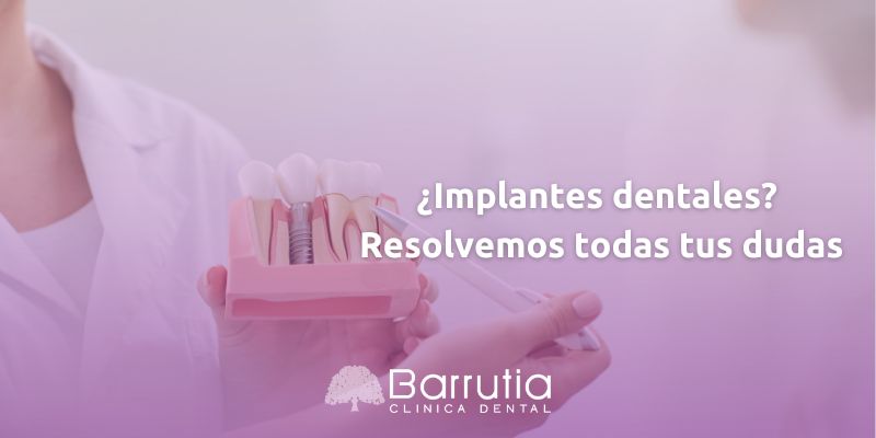 ¿Implantes dentales? Resolvemos todas tus dudas