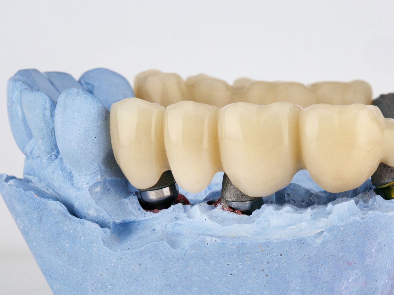 ortodoncia tradicional